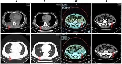 A rare adverse effects of COVID-19 vaccine in a patient with a latent tumor: A case report and literature review